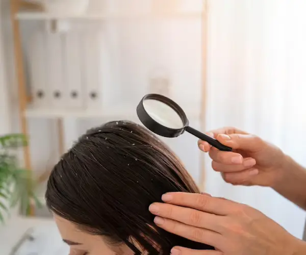 Dandruff Treatment