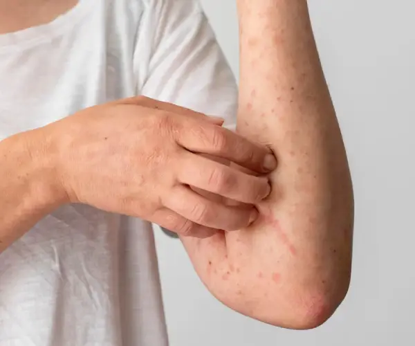 Eczema Treatment