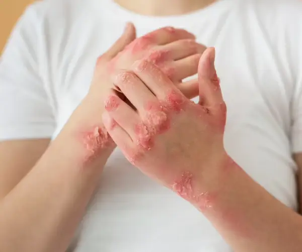 Psoriasis Treatment