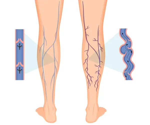 Varicose Vein Treatment